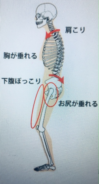 大転子 出っ張り 治らない その姿勢が原因かもしれません カイラックス